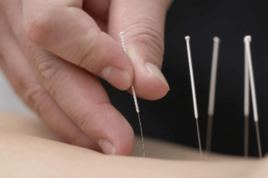 Acupuncture for Cancer